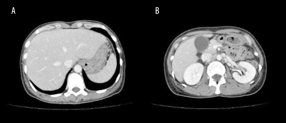 (A, B) Computed tomography of the abdomen. Abdominal computed tomography showed no findings of hepatosplenomegaly, cholecystitis, cholangitis, or a liver mass, including abscess.