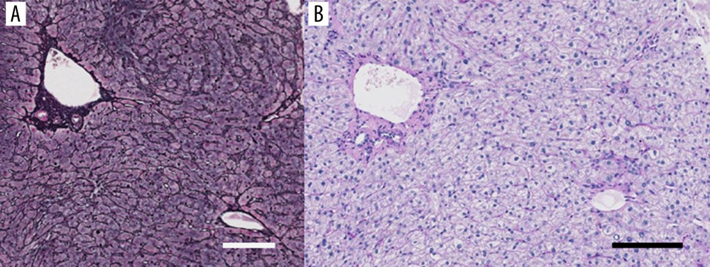 The histological examination of the liver biopsy specimen. (A) The lobular architecture is well preserved. Grocott’s methenamine sliver impregnation. Bar: 100 µm. (B) Some lymphocytic infiltrations are seen in the sinusoids as well as the portal area, although no fibrous enlargement of the portal tract is seen. No inclusion bodies are found in the hepatocytes. Periodic acid-Schiff-diastase (PAS-D) reaction after diastase digestion. Bar: 100 µm.