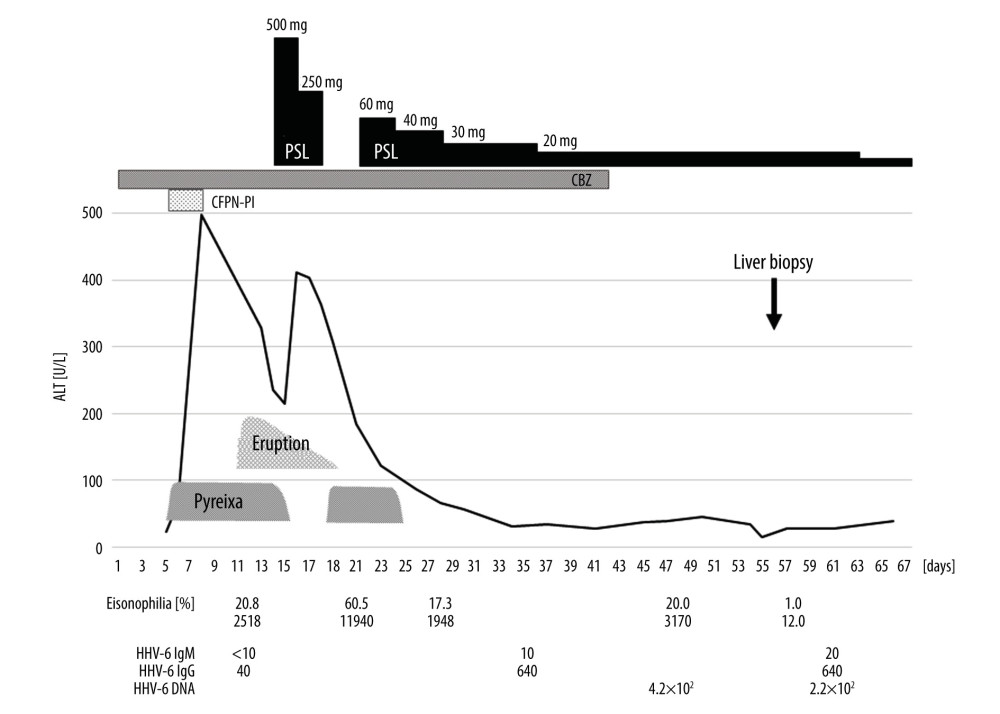 Clinical course. Because of fever and elevated liver enzyme levels, cefcapene pivoxil hydrochloride hydrate (CFPN-PI) was immediately withdrawn. However, the eosinophil count increased. In addition, an erythematous rash suddenly developed and promptly spread over the entire body. Steroid pulse therapy was administered for 6 days, which resolved the skin eruption and tended to improve the liver dysfunction. However, after stopping steroid pulse therapy, pyrexia and eosinophilia reappeared. With the re-introduction of prednisolone (PSL) therapy, the clinical manifestations improved. We also confirmed the presence of human herpesvirus 6 (HHV-6). Although carbamazepine was ceased, hepatic injury and eosinophilia persisted for a further 2 weeks. However, these consecutive clinical abnormalities eventually resolved.