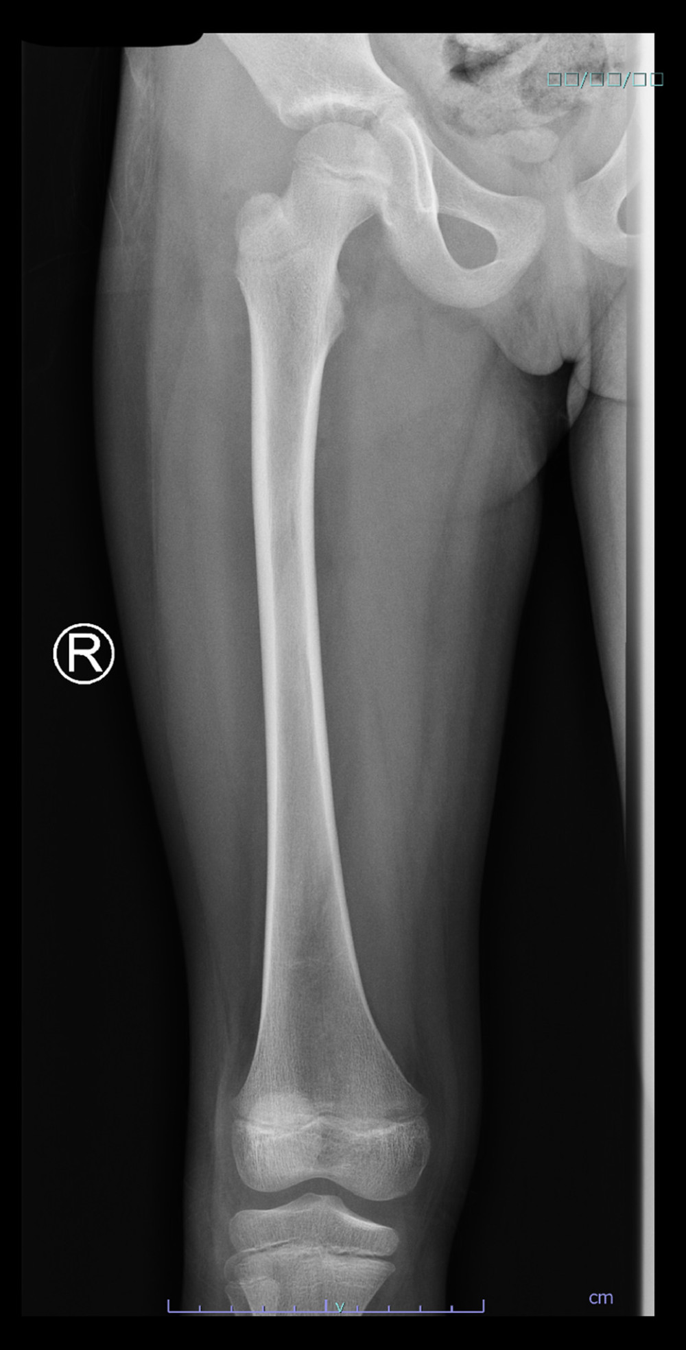 X-ray of the right femur; finding was unremarkable.