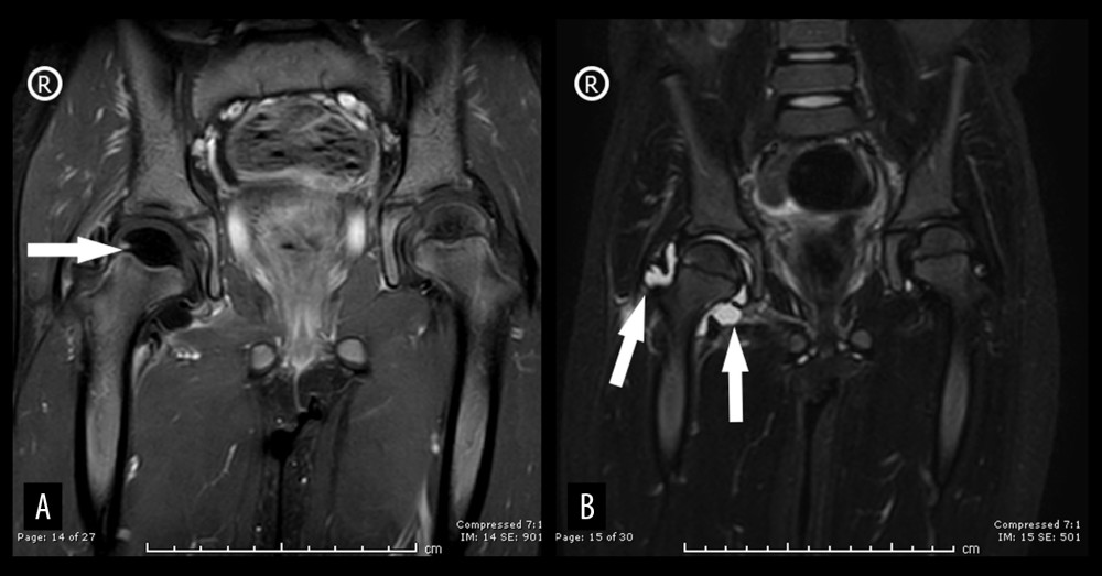 Bilateral hip magnetic resonance imaging (MRI). (A) Post-contrast fat-saturated bilateral hip T1W MRI, coronal view; arrow points to impeding avascular necrosis. (B) Bilateral hip MRI; T2W MRI, coronal view; arrows point to hyperintense area, indicating joint effusion.