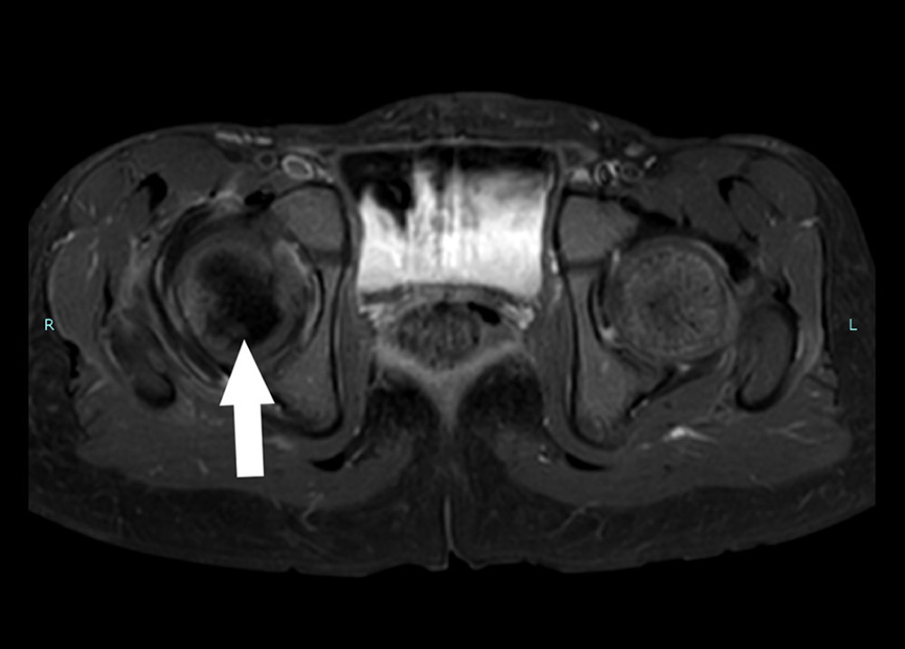 Bilateral hip magnetic resonance imaging (MRI); T2W MRI, axial view, arrow points to focal area of reduced marrow signal intensity, indicating impeding avascular necrosis.