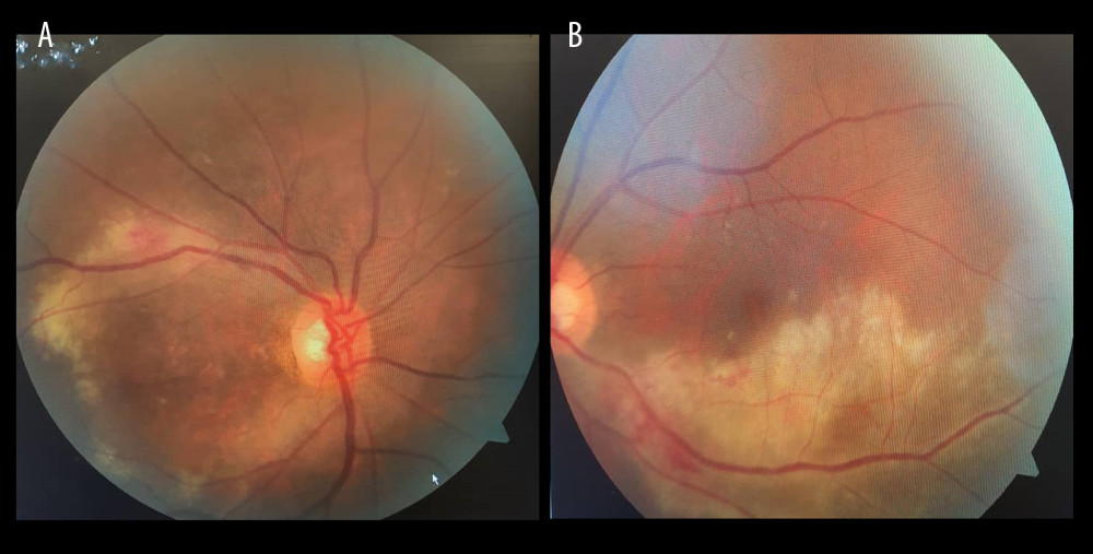 (A) Right-eye retinitis with retinal hemorrhage along superior temporal vessels. (B) Left-eye retinitis patch along inferior temporal vessels with retinal hemorrhage.
