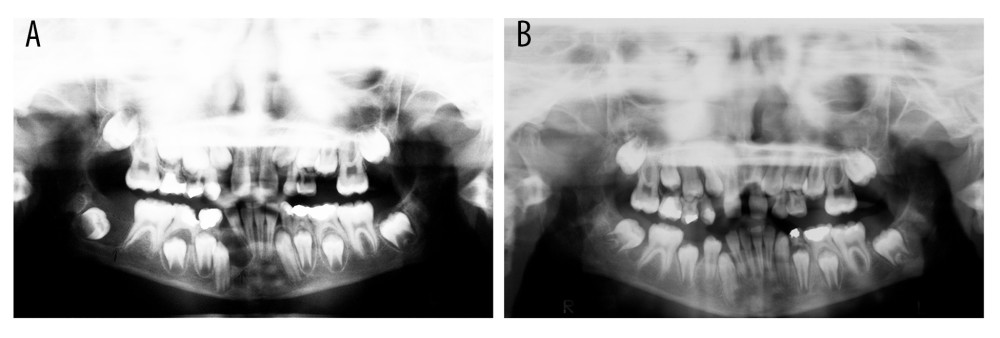 (A) Dentigerous cyst associated with tooth 43. (B) Radiolucent area at the distal surface of the tooth 37. After 3 years, it had expanded to the ascendant branch of the mandible, and it was diagnosed as an odontogenic keratocyst.