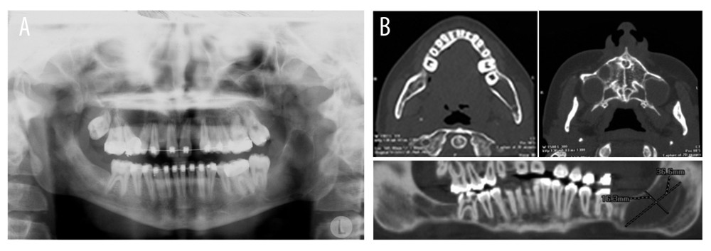 (A) Radiographic examination showing a mandibular lesion compromising the distal area of tooth 37 and another less extensive area in the maxilla between the roots of teeth 14 and 15. (B) Tomography showing areas of uniform, well-circumscribed bone rarefaction in the maxillary posterior region and the left ascending branch of the mandible.