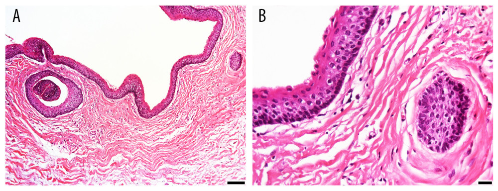 (A, B) Histopathological appearance of the maxillary lesion showing uniform epithelial lining characterized by palisaded hyperchromatic basal cell layer composed of cuboidal to columnar cells and the luminal surface has wavy (“corrugated”) parakeratotic epithelial cells, suggesting the diagnosis of OKC.