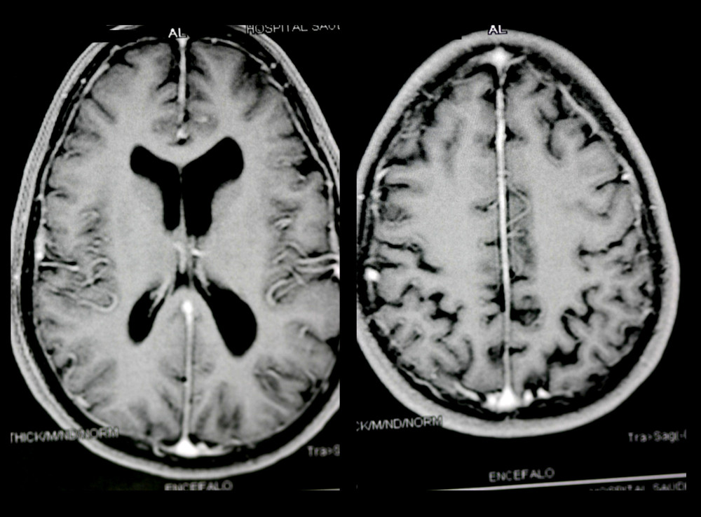 Magnetic resonance imaging of the encephaly, showing the calcification of the falx cereberi in the interhemispheric region and at the tentorium.