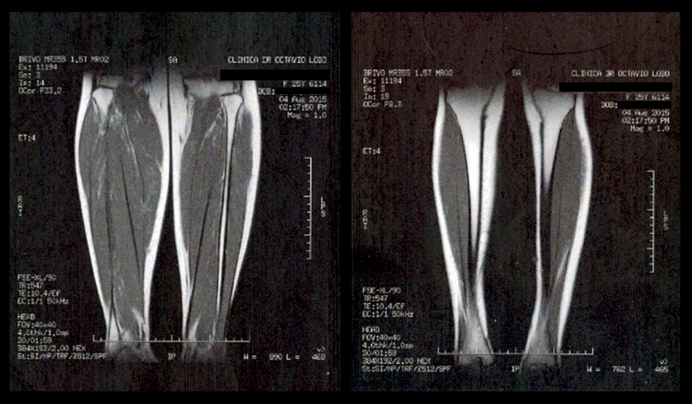 Magnetic resonance imaging of the legs showing osteolytic areas in both legs, with different sizes.