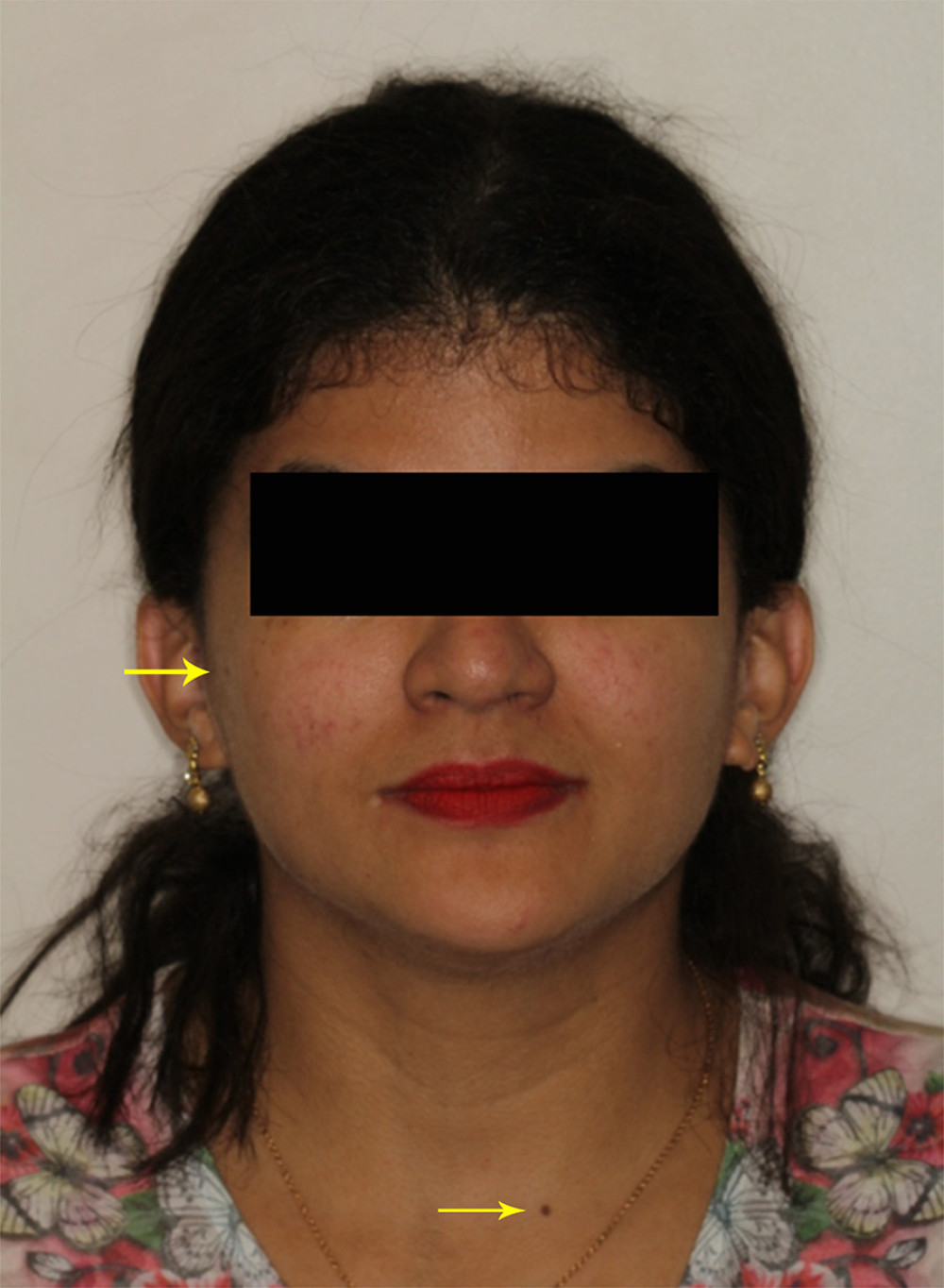 Head and neck skin maculae that were posteriorly removed by the dermatologist as a preventive intervention, avoiding the occurrence of basal cell carcinomas.