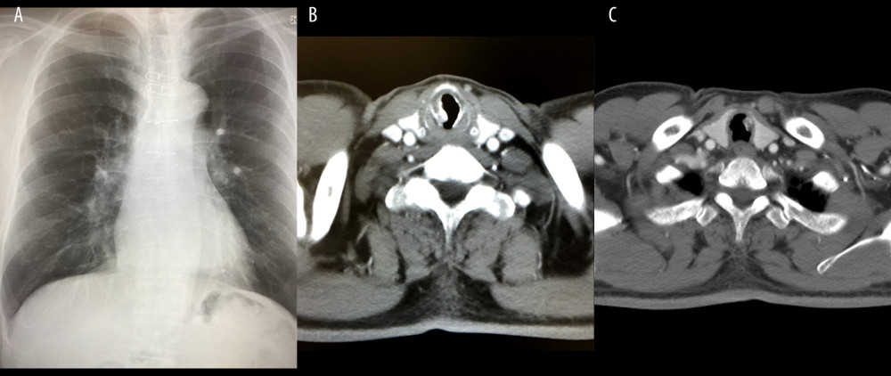 Preoperative chest X-ray and computed tomography (CT) scan images. (A) Chest X-ray image before surgery; (B) CT scan image 1 cm beneath the glottis; (C) CT scan image 3 cm beneath the glottis.