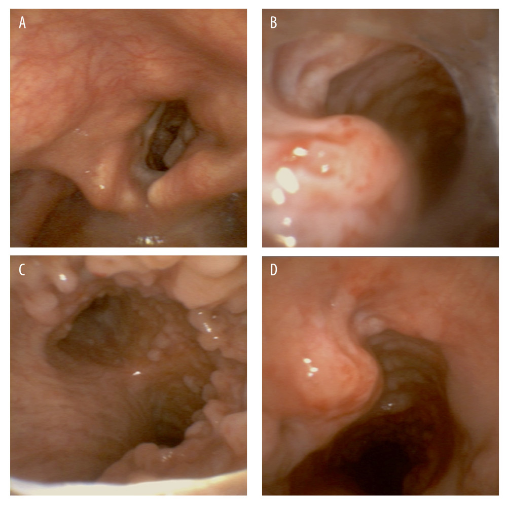 Bronchoscopy images during surgery. (A) Glottis; (B) bony nodules protruding toward the tracheal lumen; (C) tracheal bifurcation; (D) postoperative trachea.