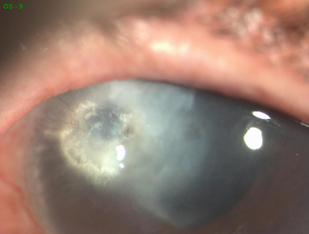 Regression of corneal ulcer after 5 weeks of 0.66% PVI, hyaluronic acid, glycerol, and medium-chain triglycerides (IODIM®, Medivis S.r.l.) treatment (4 times/day).