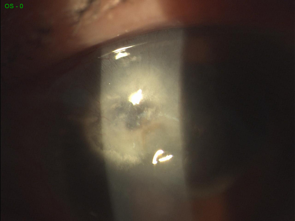 Three months after the first visit. Corneal ulcer closure confirmed after 5 weeks of 0.66% PVI, hyaluronic acid, glycerol, and medium-chain triglycerides (IODIM®, Medivis S.r.l.) therapy (2 times/day) and autologous serum eyedrops (4 times/day).