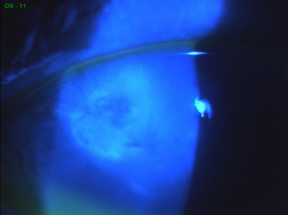 American Journal of Case Reports LowConcentration (0.66) Povidone