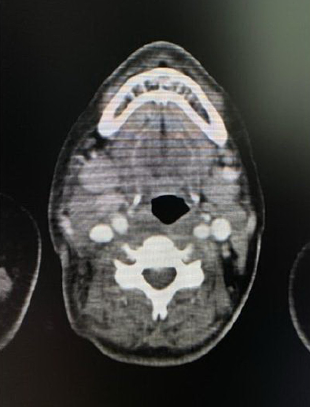 Axial section of CT neck showed right-sided multiple cervical lymph nodes; the largest was 2.8×2.3 cm.