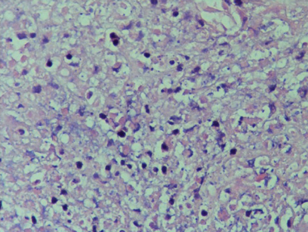 Histopathology of cervical lymph node showed nuclear debris and necrosis with infiltration of many histiocytic cells.
