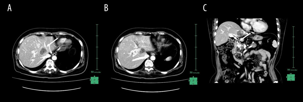 (A) An enhanced CT examination revealed that the middle hepatic vein was encased by a low-density mass (white arrow). (B, C) The portal phase of the CT examination also revealed cavernous transformation from the infrapancreatic superior mesenteric vein to the intrahepatic vessels (white arrow).