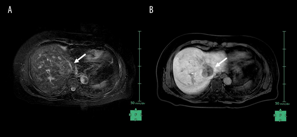 The findings of gadolinium-ethoxybenzyl-diethylenetriamine pentaacetic acid magnetic resonance imaging are shown. (A) T2-weighted image revealed that an iso-intensity mass was located in segment 4 (white arrow). (B) The tumor showed low intensity in the hepatobiliary phase (white arrow).