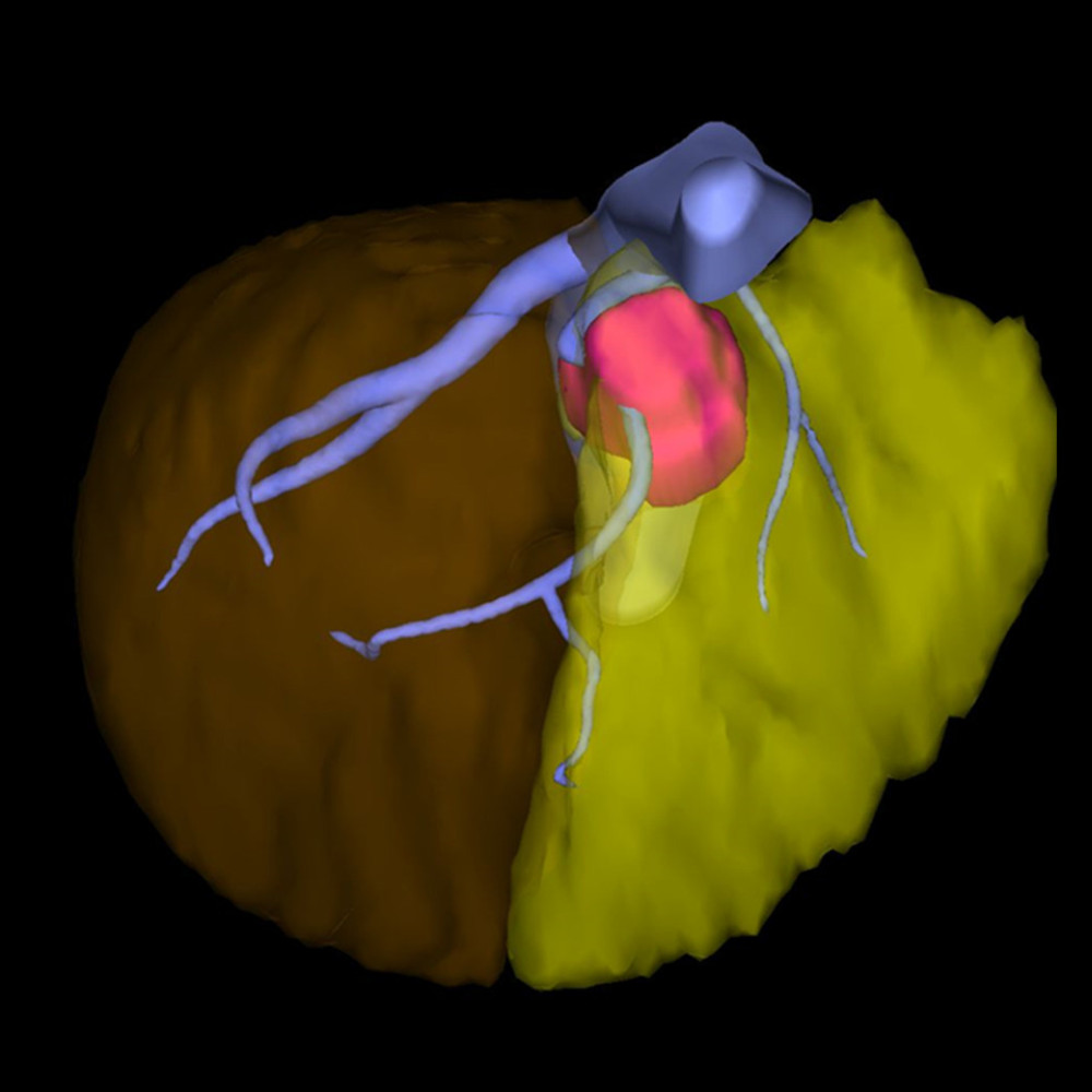 Preoperative volumetry is shown. The middle hepatic vein was encased by the tumor; therefore, we planned to divide the root of the middle and left hepatic veins. The volume of the resected liver, remnant liver, and the tumor were estimated as 248 mL (yellow), 701 mL (brown), and 19 mL (pink), respectively.
