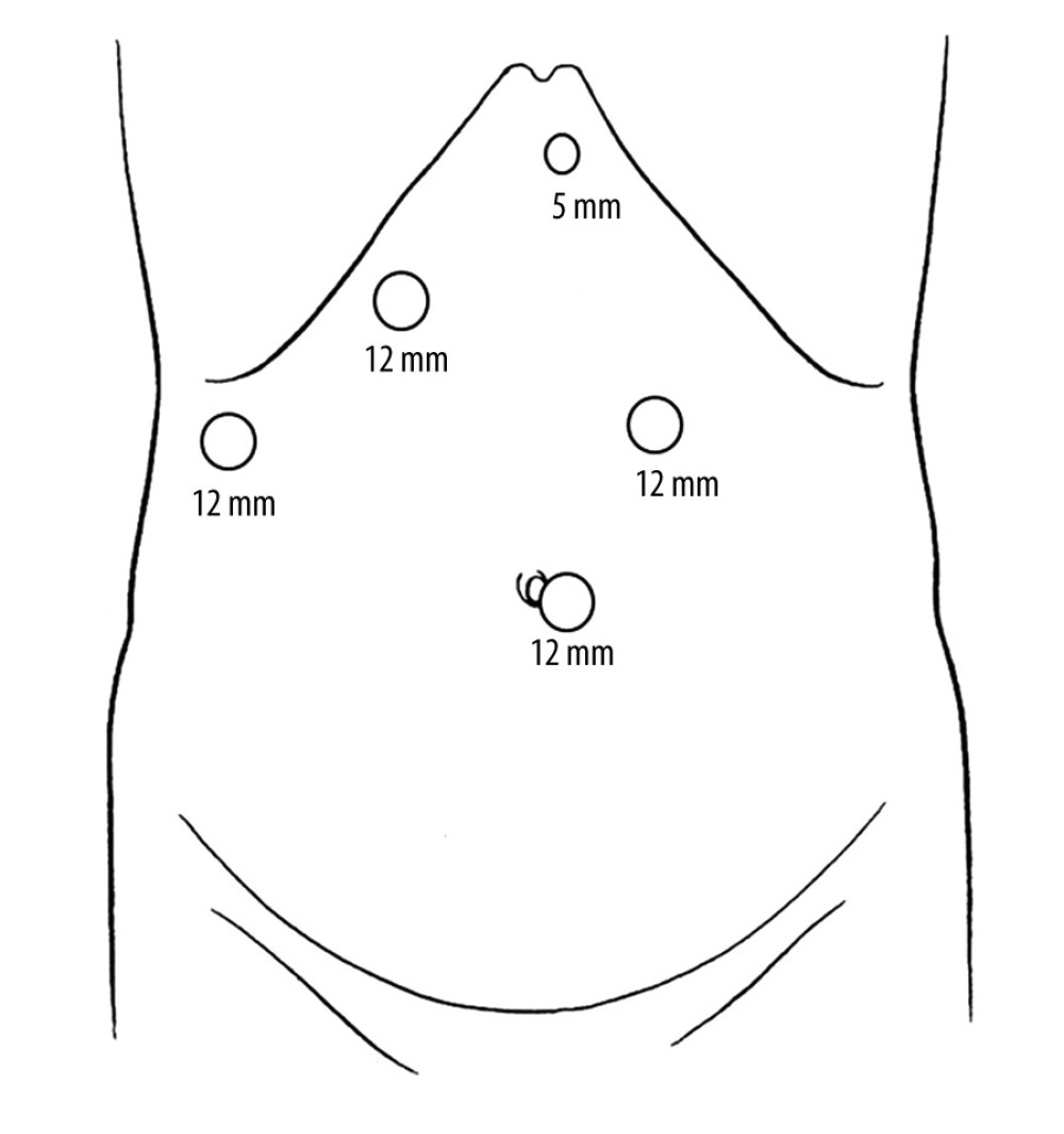 Trocar placements are shown.