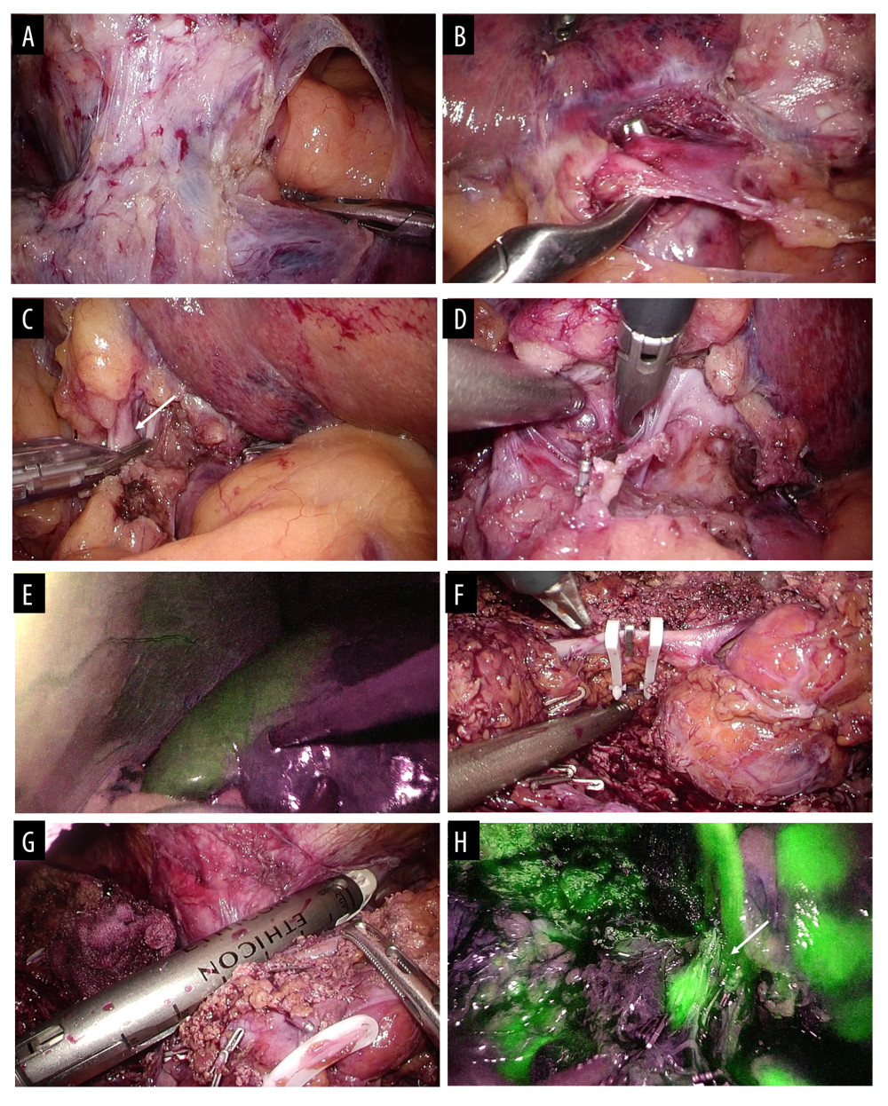 Surgical procedure is shown. (A) The root of the left and middle hepatic vein was visualized. (B) The ductus venosus was visualized and transected. (C) The left hepatic artery was identified and clipped (white arrow). (D) Small vessels from cavernous transformation were individually clipped and divided. (E) Demarcation line was clarified by ICG imaging. (F) The middle hepatic vein was exposed and divided at the tumor invasion. (G) The roots of the left and middle hepatic veins were transected by a linear stapler. (H) The left hepatic duct was visualized by ICG imaging (white arrow).