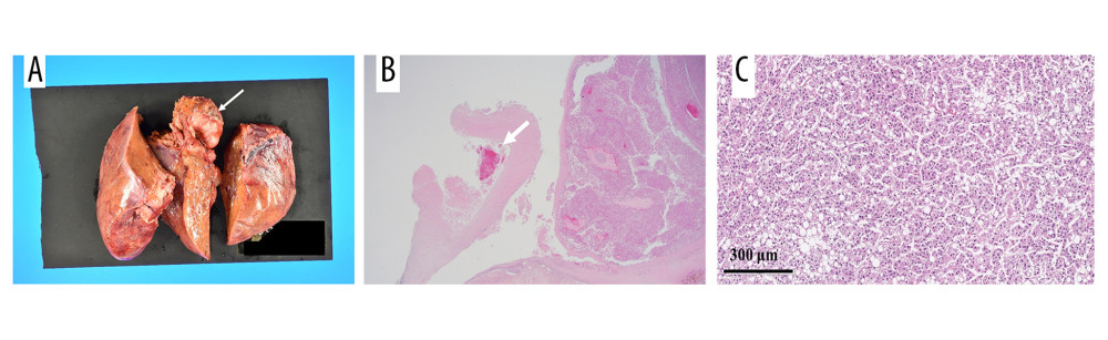 (A) Macroscopic findings showed that a capsulized tumor of 38×26 mm in size was located at segment 4 (white arrow). (B) The middle hepatic vein was also observed beside this tumor, and intraluminal coagulative necrosis seemed a part of a tumor thrombosis (white arrow). (C) A magnified view (×100) also revealed that the moderately differentiated HCC formed a pseudoglandular pattern and cord-like structures.