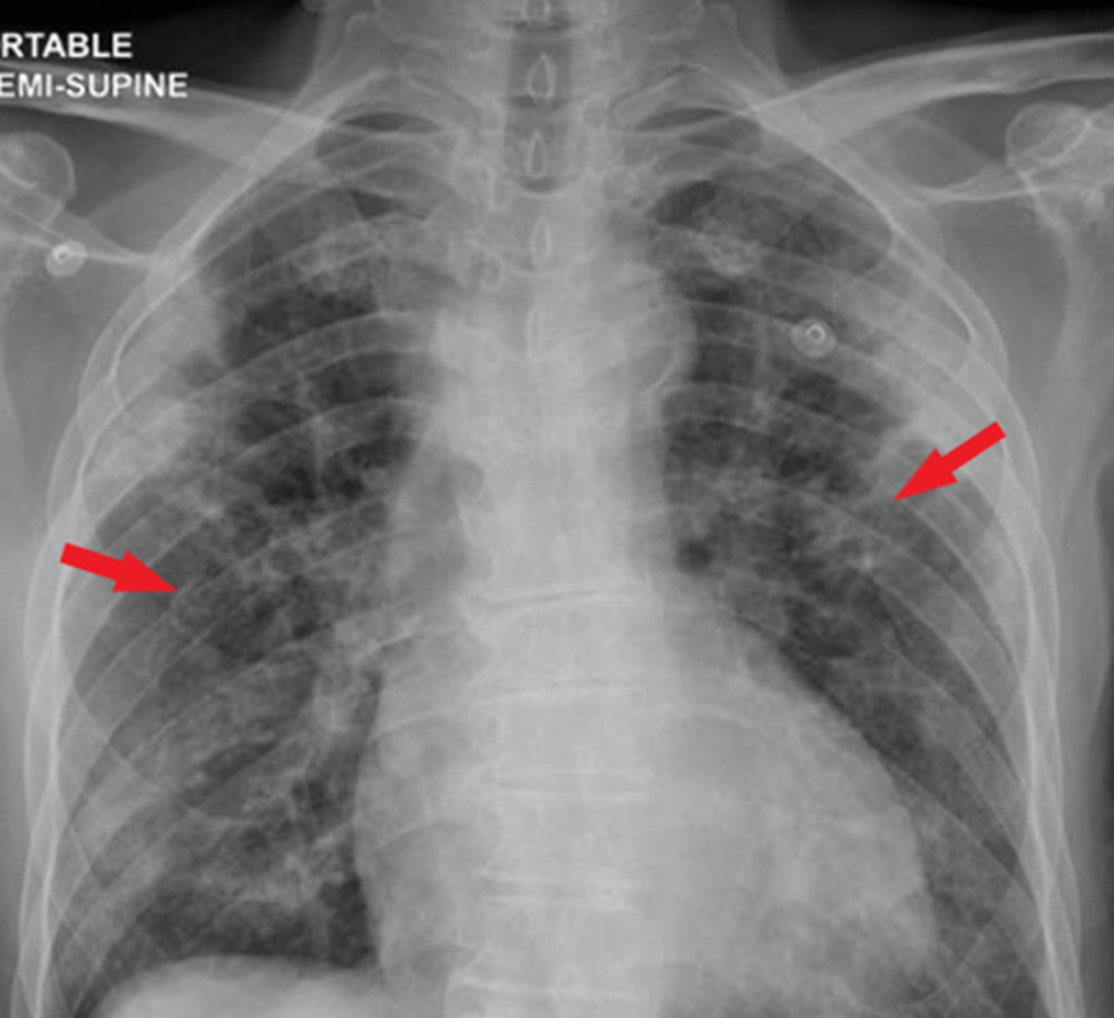 Chest X-ray. Red arrows point to bilateral patchy infiltrates.