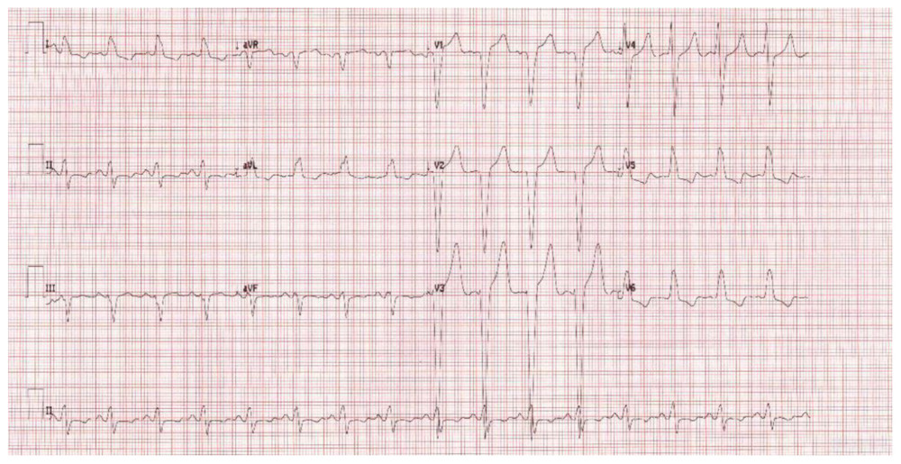 Electrocardiogram. An electrocardiogram reveals left bundle branch block, broad QRS, and a notched (“M”-shaped) R wave in the lateral leads (v5–v6).
