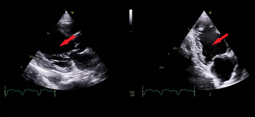 Transthoracic echocardiography. The red arrows point to a thrombus in the left ventricle.