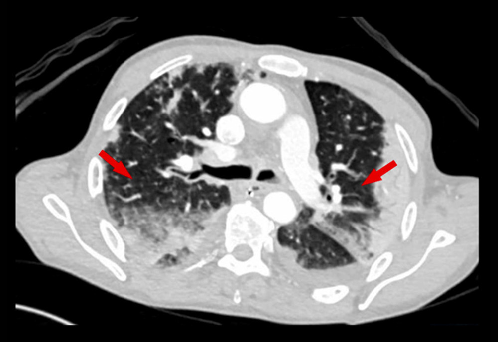 Computed tomography scan of the chest. The red arrows point to bilateral consolidations with diffuse ground-glass opacities.