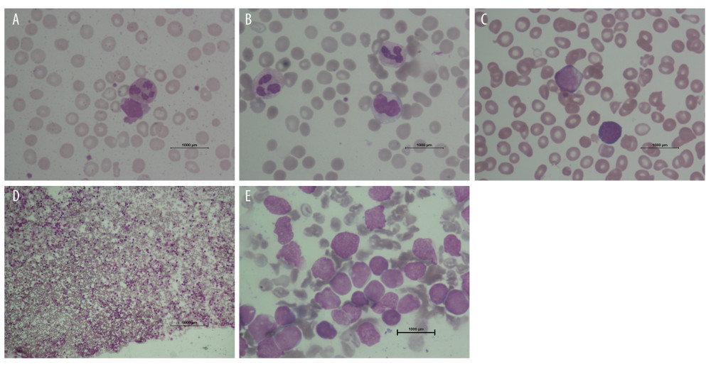 (A) Peripheral blood smear (admission period at the first hospital, with acute febrile illness) showing abnormal white blood cells with adequate platelet (Wright-Giemsa stain, original magnification ×1000). (B, C) Peripheral blood smear (admission period at the second hospital, with persistence fever and cytopenic condition) showing a small number of red blood cells with lymphoblastic cells and decreasing numbers of platelets (Wright-Giemsa stain, original magnification ×1000). (D, E) Bone marrow smear showing hypercellularity of marrow with predominately lymphoblastic cells (Wright-Giemsa stain, original magnification ×1000).