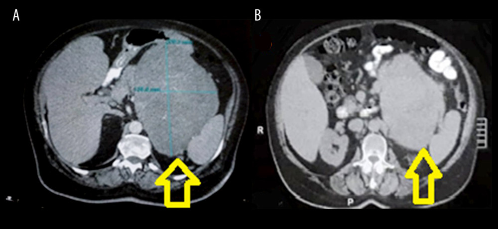 (A, B) CT scan with abdominal mass next to the left kidney.