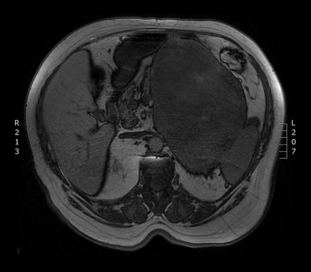 MRI scan with abdominal mass next to the left kidney.