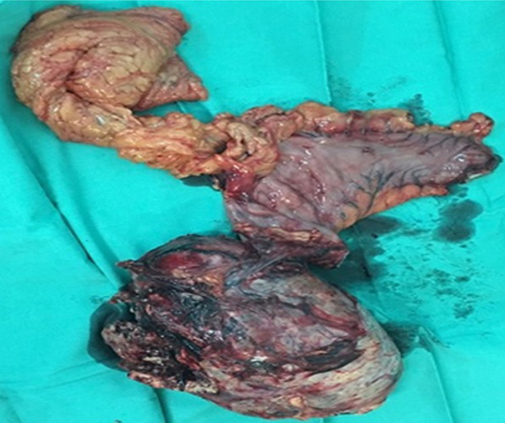 Histopathologic specimen from the first operation. Adrenal mass with the stomach and greater omentum attached.