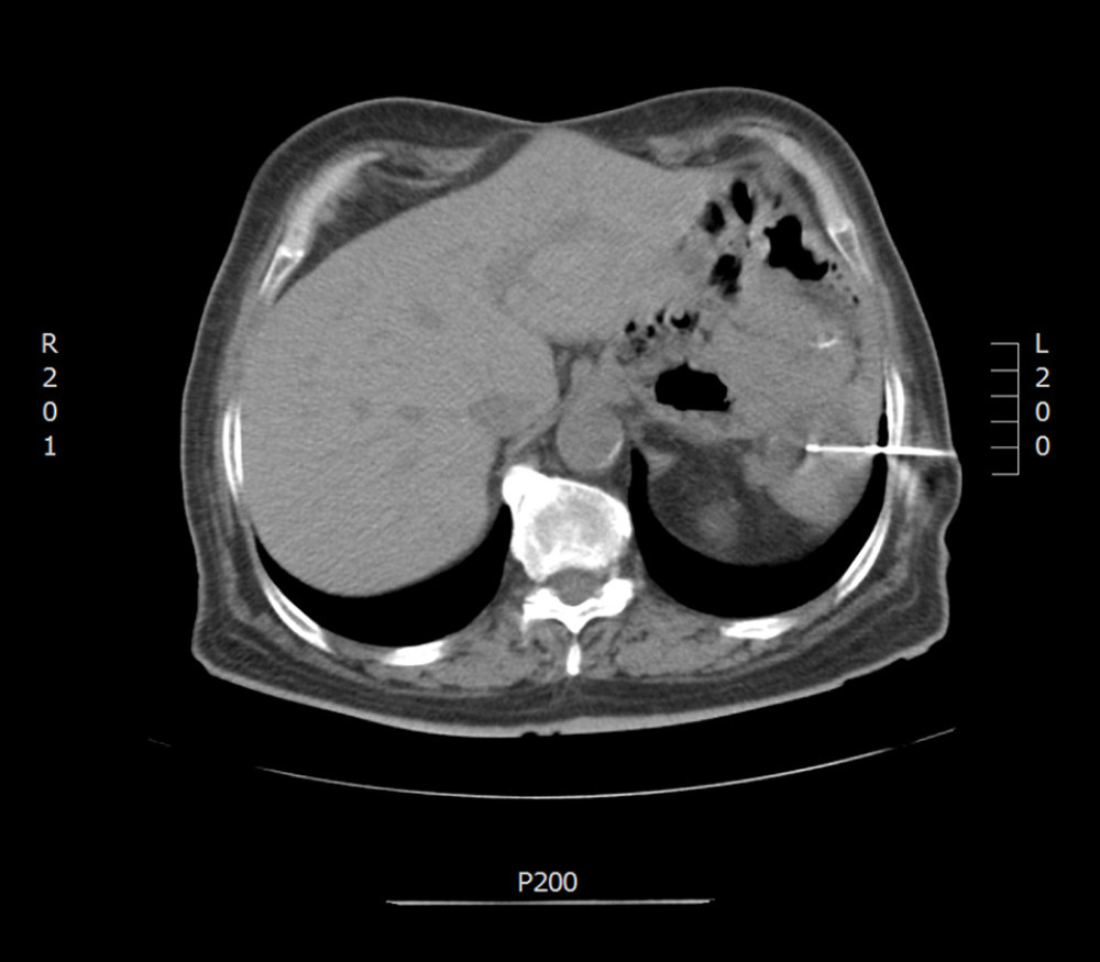 CT-guided biopsy of the recurred tumor, albeit the patient underwent radical surgical excision and adjuvant chemotherapy.