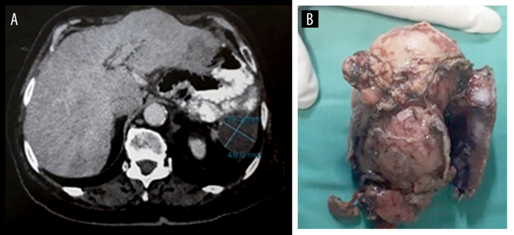(A) CT scan revealing the recurrent tumor superior to left kidney (B): Histopathologic specimen from the second operation. Recurrent tumor excised. The tail of the pancreas and a small part of the left lobe of the liver were also removed during the second operation.