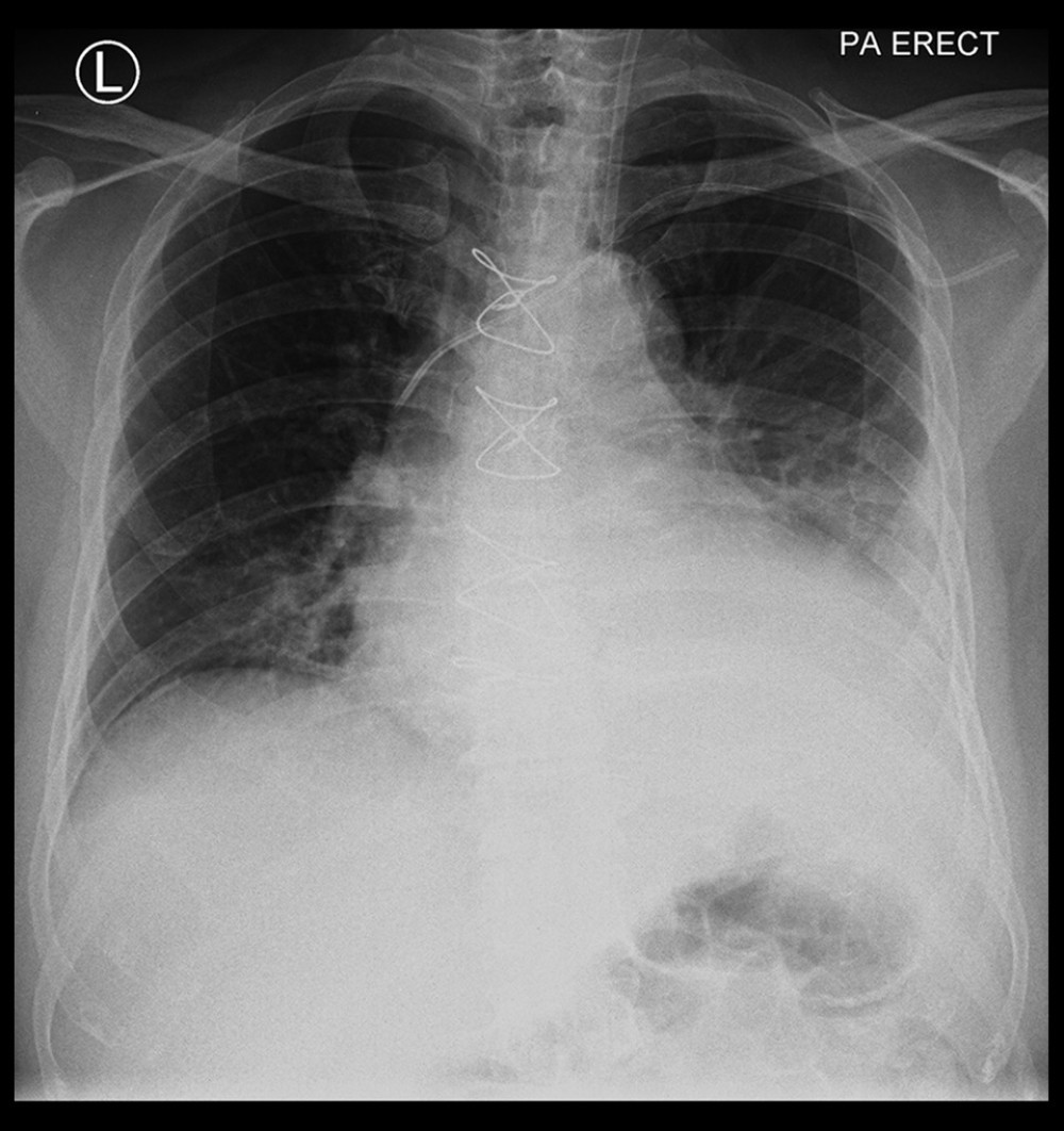 PA chest radiograph of a 48-year-old man at 5 days following triple-vessel coronary artery bypass graft (CABG) surgery. The chest X-ray shows cardiomegaly and an area of lung consolidation in the left lower lobe.