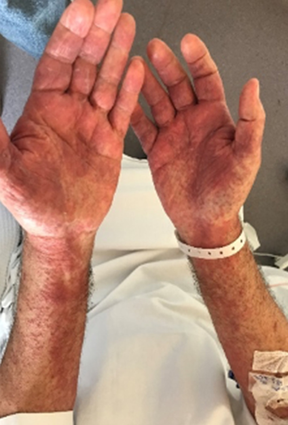 Maculopapular rash over the palms.
