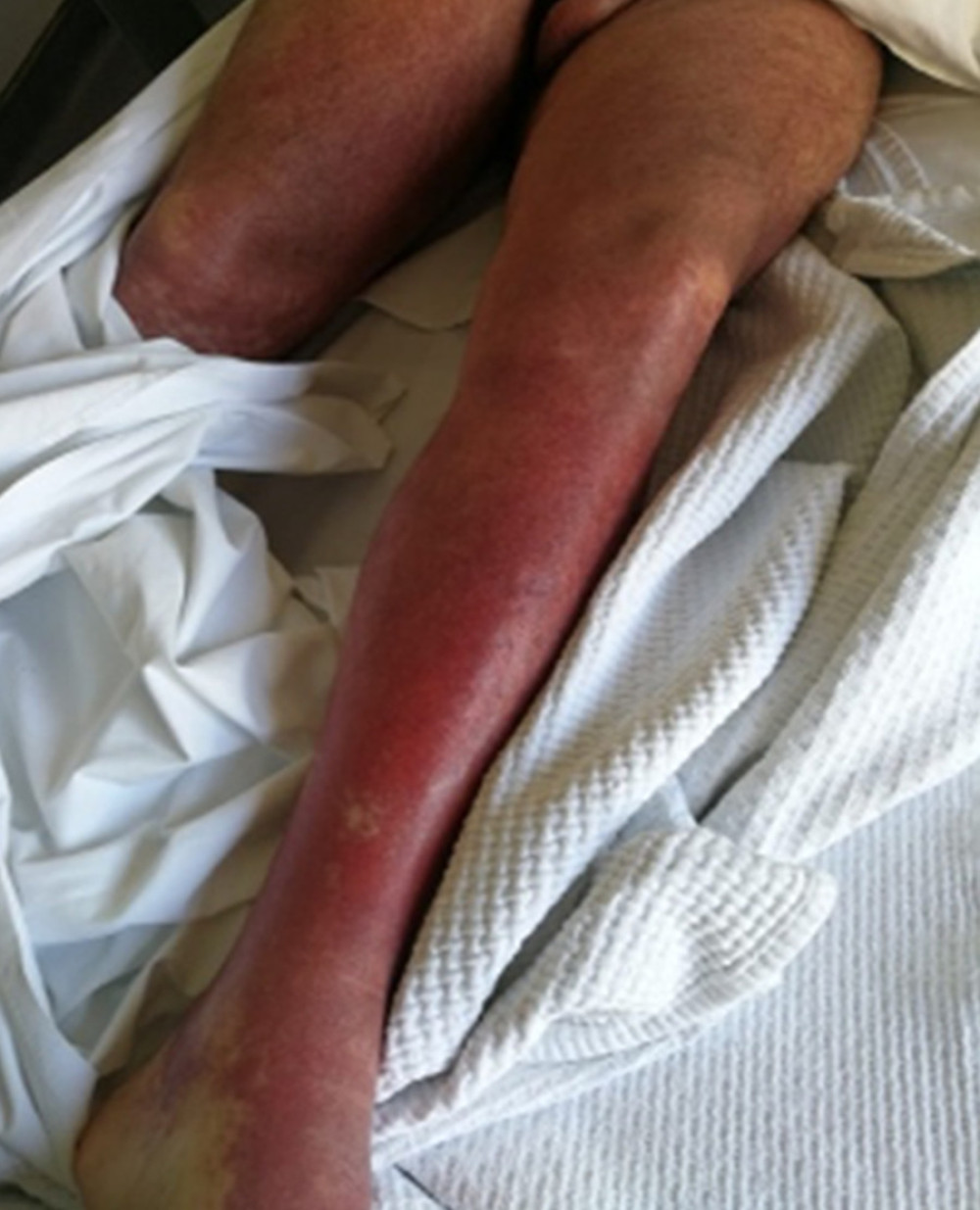 Purpura and petechia over the lower extremities.