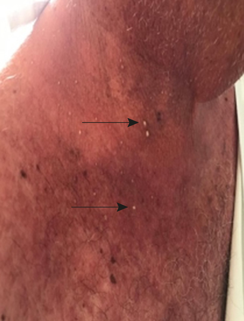 Exanthematous pustulosis over the neck and upper chest. Arrows point to pustulosis.