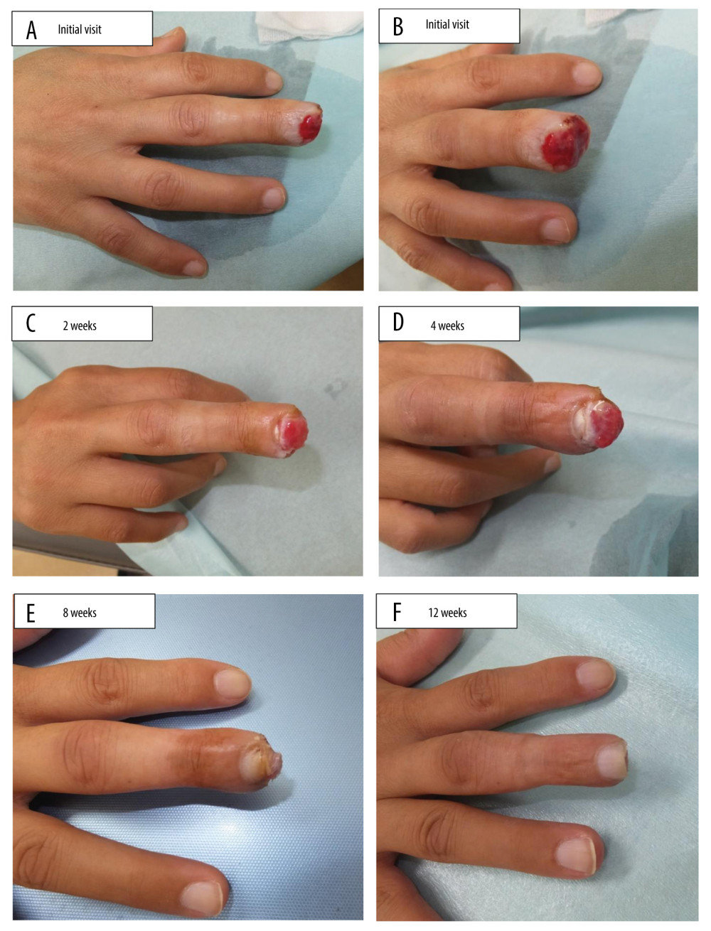 Wound healing process from initial visit to epithelialization Initial presentation of fingertip amputation injury on the third finger of the right hand. The distal phalanx of the finger is exposed during the initial visit (A, B). Granulation increased at 2 weeks (C). The tip regained a shape similar to that of the original finger at 4 weeks (D). Epithelialization was near completion at 8 weeks (E). Complete epithelialization at 12 weeks (F).
