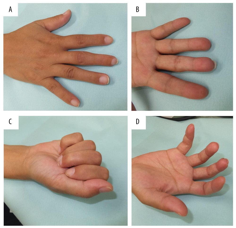 Appearance and range of motion after 39 weeks Fingertip on the palmar and dorsal surfaces at 39 weeks (A, B). Range of motion of the fingertip is normal (C, D).