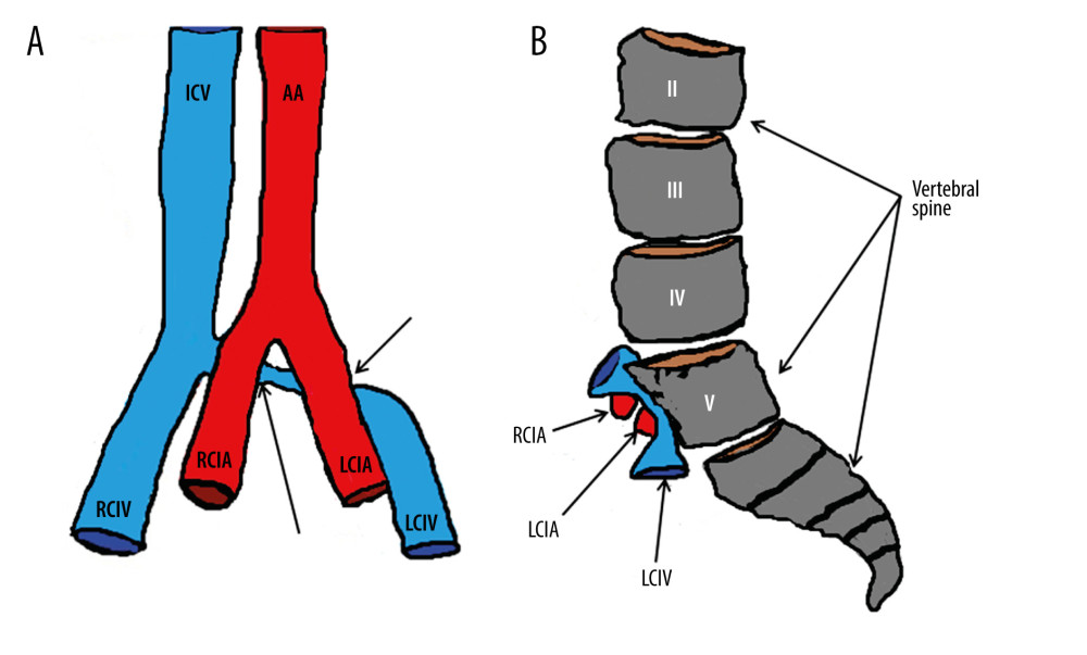 Scheme describing the main anatomical structures involved in the present case of May-Thurner syndrome. (A) Diagram showing the relationship between the common iliac arteries and the common iliac veins in a coronal plane. In this scheme, we highlight the 2 points in which the LCIV was compressed (arrows). (B) Diagram showing the relationship between the common iliac arteries, the LCIV, and the vertebral spine in a sagittal plane. AA – abdominal aorta; ICV – inferior vena cava; RCIV – right common iliac vein; LCIV – left common iliac vein; LCIA – left common iliac artery; RCIA – right common iliac artery.