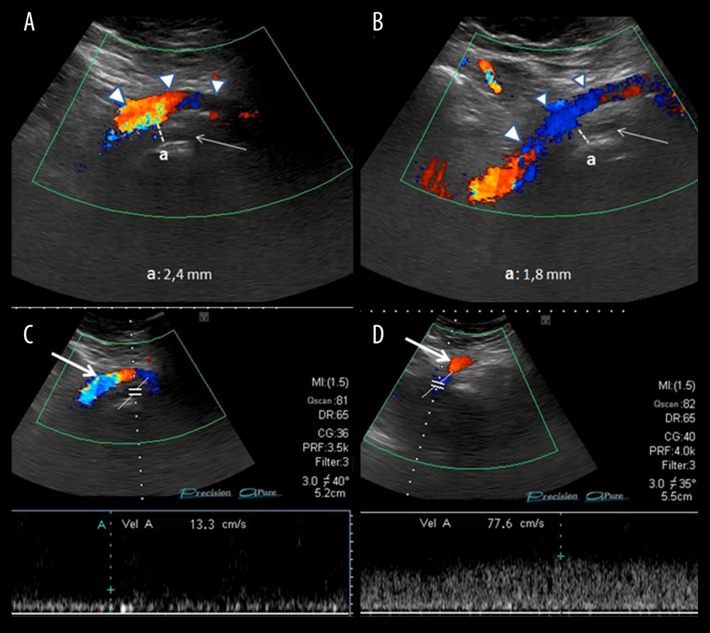 Longitudinal ultrasound scan of the LCIV and common iliac arteries. (A) Measurement of minimum distances (a: 2.4 mm) between the RCIA (arrow heads) and the vertebral spine. Arrow indicates the thrombotic tract of the LCIV. (B) Measurement of minimum distances (a: 1.8 mm) between the LCIA (arrow heads) and vertebral spine. Arrow indicates the LCIV. (C) Duplex Doppler ultrasound for measurement of PSV in the pre-stenotic tract of the LCIV. Arrow indicates right common iliac artery. (D) Duplex Doppler ultrasound measurement of PSV in the post-stenotic tract of the LCIV. Arrow indicates left common iliac artery. LCIV – left common iliac vein; LCIA – left common iliac artery; RCIA – right common iliac artery; PSV – peak speed velocity.