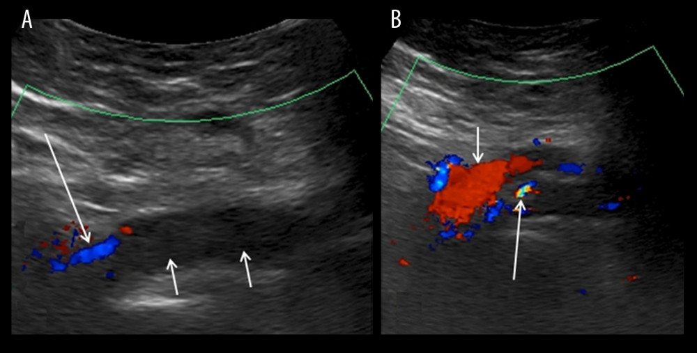 Color Doppler ultrasound of the LCIV. (A) Thrombotic tract with absence of chromatic signals (short arrows). Flux signals in pre-stenotic tract (long arrow). (B) Turbulent flow in the LCIV, with chromatic aliasing (long arrow) in the post-stenotic tract. Short arrow indicates left common iliac artery. LCIV – left common iliac vein.