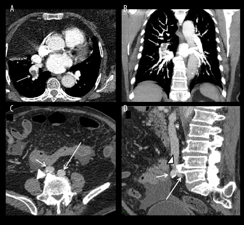 MDCT angiography indicating pulmonary embolism. (A) In the axial reconstruction, an enhancement defect is visible, affecting the right pulmonary artery (arrow). (B) In the coronal reconstruction, some enhancement defects are better highlighted (arrow). (C) In this axial reconstruction, the RCIA (short arrow) and the LCIA (long arrow) are visible, which are compressing the LCIV against the osteophyte (arrow head) and against the body of the fifth lumbar vertebra, respectively. (D) This sagittal reconstruction shows the RCIA (long arrow) compressing the LCIV (short arrow) against an osteophyte (arrow head) of the fifth lumbar vertebra (L5; arrow head). MDCT – multidetector computed tomography; RCIA – right common iliac artery; LCIA – left common iliac artery; LCIV – left common iliac vein.