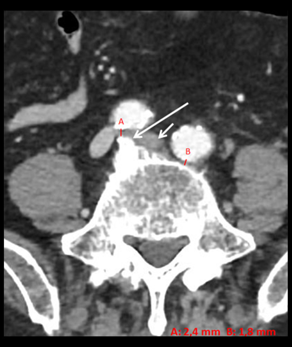 MDCT angiography. In this axial reconstruction, we can see the 2 compressions of the LCIV caused by the right and left common iliac arteries and the measurements (dashed lines) of the minimum distance between the vertebral spine and the aforementioned vessels. Long arrow indicates the osteophyte of the fifth lumbar vertebra; short arrow indicates the LCIV. MDCT – multidetector computed tomography; LCIV – left common iliac vein.