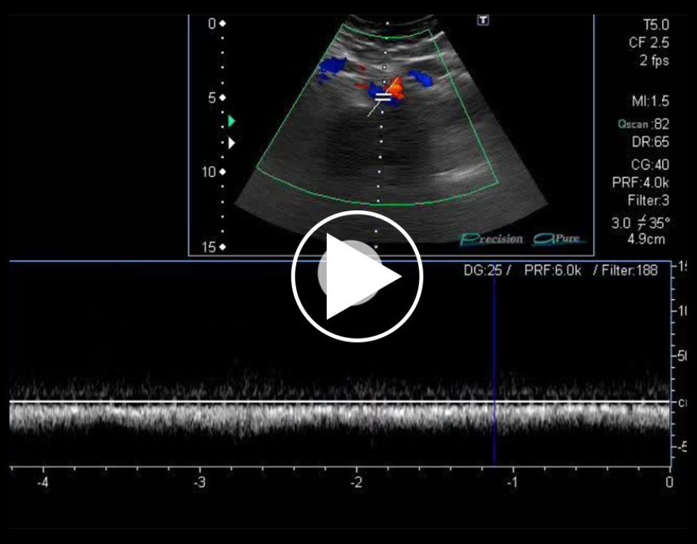 Duplex Doppler ultrasound measurement of the peak speed velocity in the post-stenotic tract of the left common iliac vein.