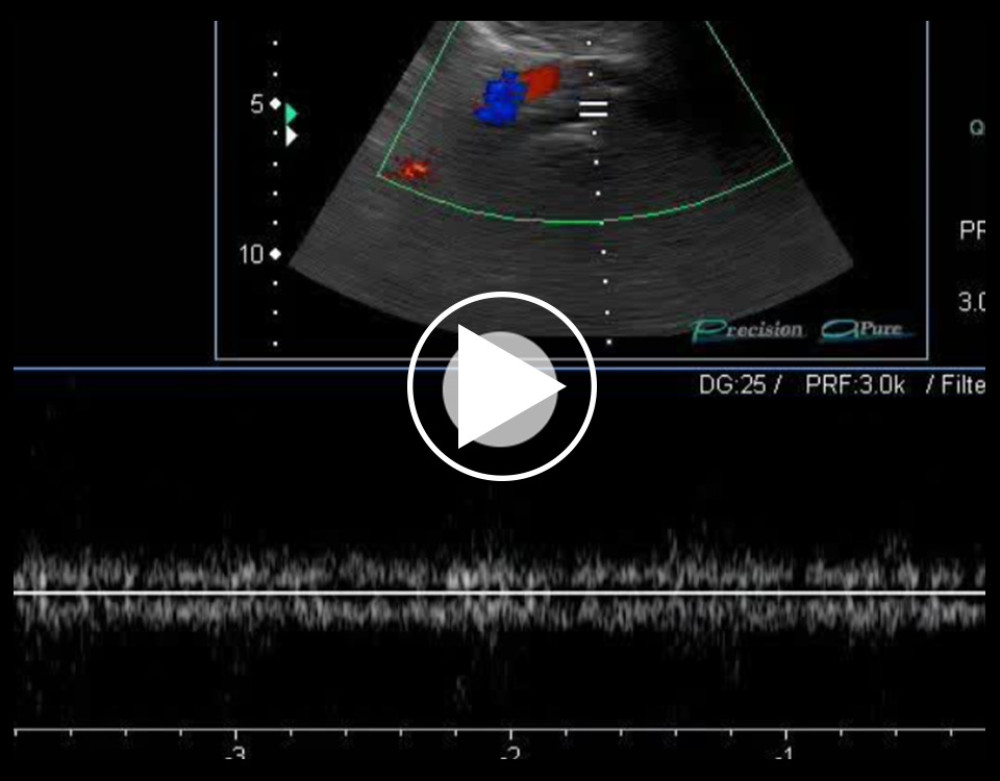 Duplex Doppler ultrasound measurement of the peak speed velocity in the pre-stenotic tract of the left common iliac vein.