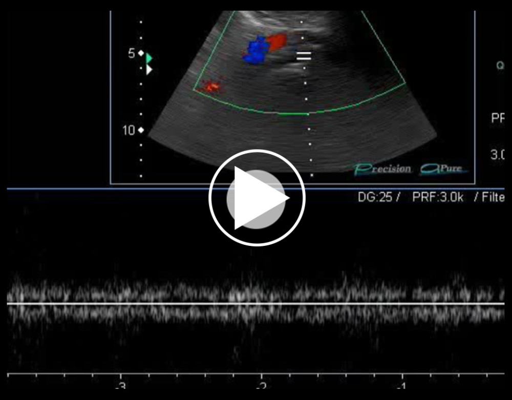 Duplex Doppler ultrasound measurement of the peak speed velocity in the pre-stenotic tract of the left common iliac vein.